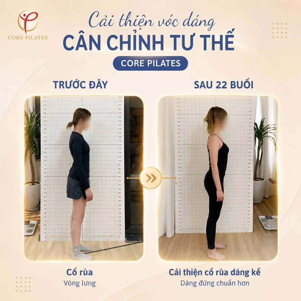 Hình ảnh trước và sau quá trình tập Pilates cải thiện tư thế